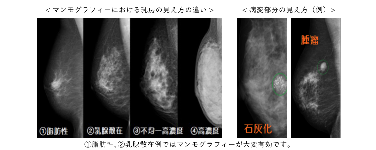 乳がん検診 G O女性ヘルスケアクリニック